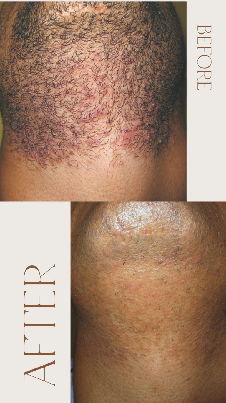 Avant après épilation laser barbe homme