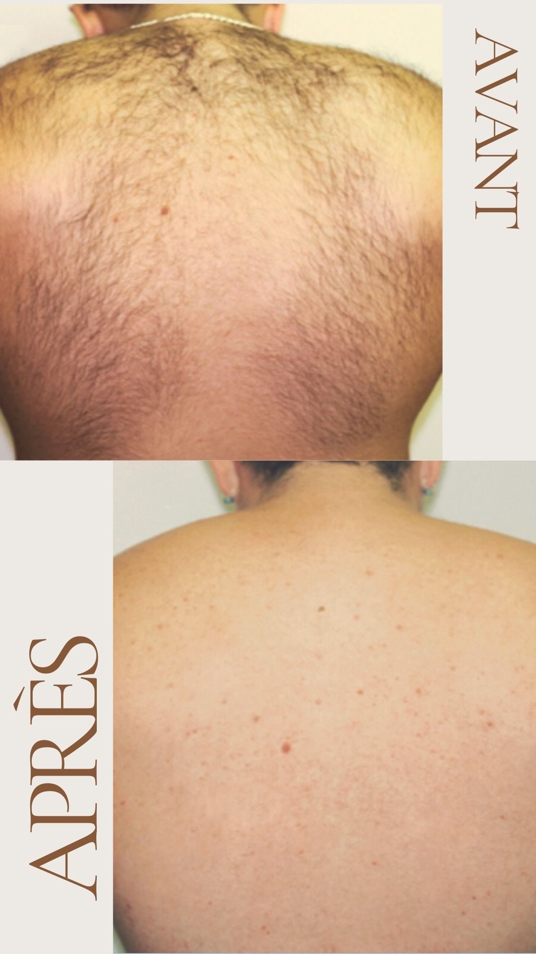 Avant après épilation laser dos homme